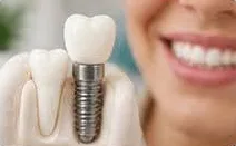 Implante Dentário